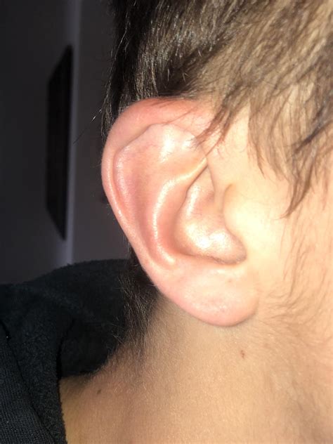 Draining Cauliflower Ear