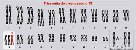 O Que A S Ndrome De Patau Trissomia Causas E Sintomas Verloop Io