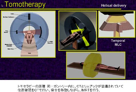 トモセラピーによる高精度放射線治療