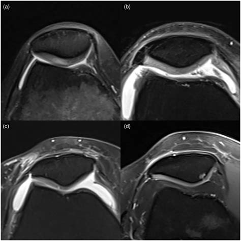 Chondromalacia patella was classified using a modified Noyes ...