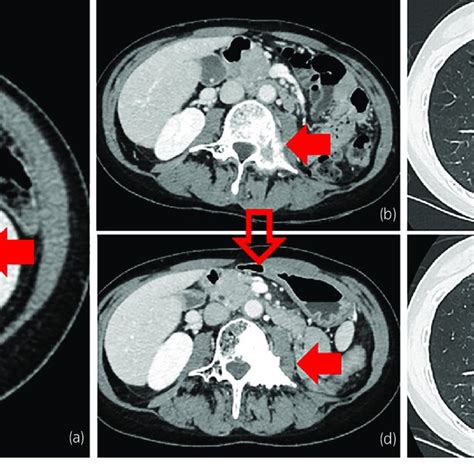 Imaging Manifestation Of Left Renal Pelvic Uc In Lynch Syndrome The