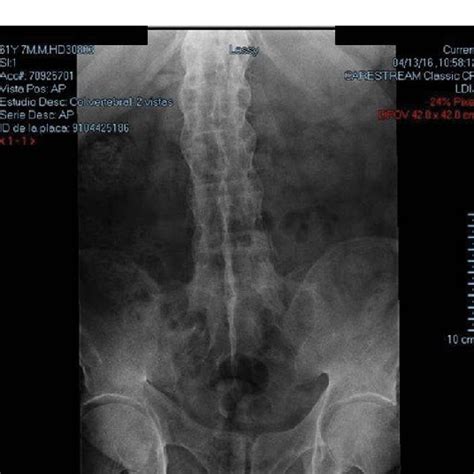 Characteristic " bamboo " spine. | Download Scientific Diagram