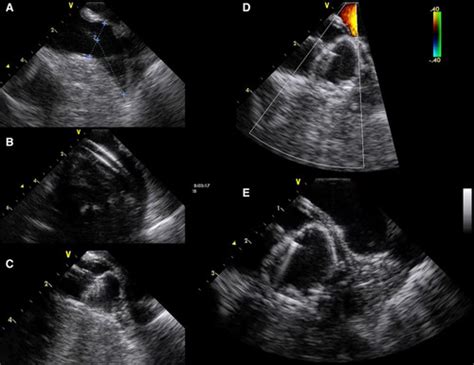 Use Of Intracardiac Echocardiography In Interventional Cardiology