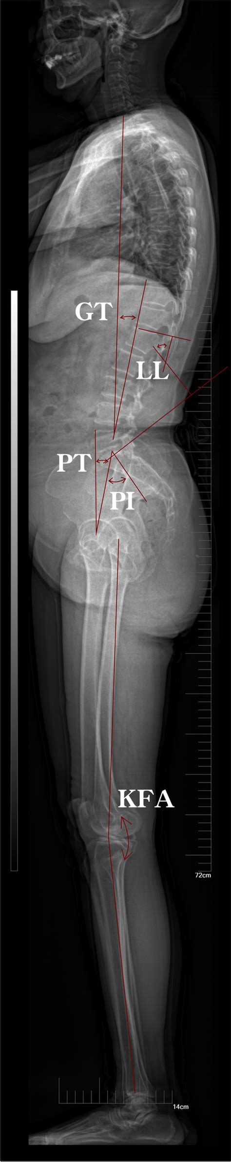 Sagittal Parameters In The Eos System Gt Global Tilt Ll Lumbar