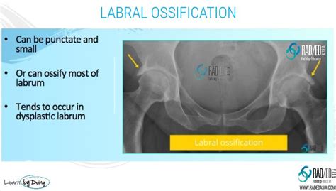 Hip Labrum Ossification Mri Labral Abnormalities More Than Just Tears