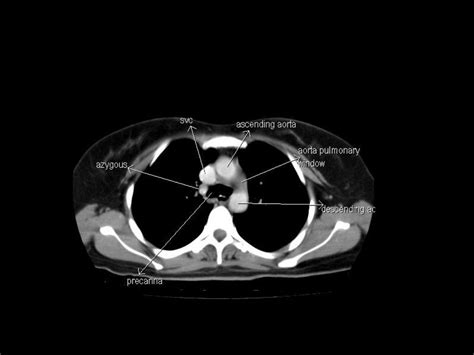 CT Anatomy