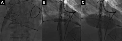 Transseptal Transcatheter Mitral Valve Replacement Using Balloon