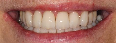 Before And After Holistic Dentistry In Costa Rica Natural Dental Care