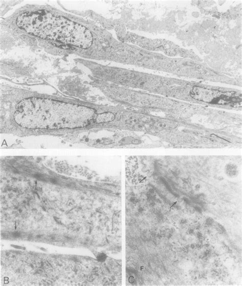 A Low Power Electron Micrograph Of Spindle Shaped Tumour Cells