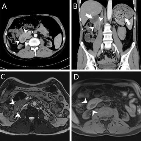 Case Presentation Of Duodenal Obstruction Caused By Complete Annular Pancreas Journal Of The