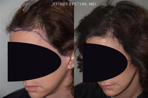 Forehead Reduction Surgery Photos Miami FL Patient37123