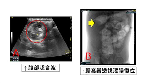 1歲娃腸套疊 發燒吐一天 自由健康網