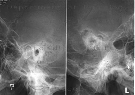 Mastoiditis Radiology