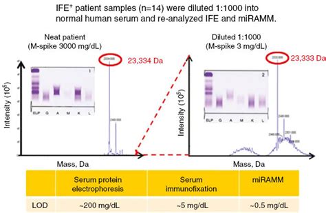 Immunofixation Shows Igm Monoclonal Protein With Kappa Light Chain