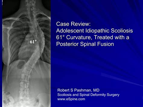 Case Review 4 Adolescent Idiopathic Scoliosis With 61 Degree Curvature Ppt