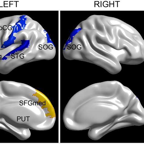 The Spatial Distribution Of Cortical Regions Showing Significant Gender