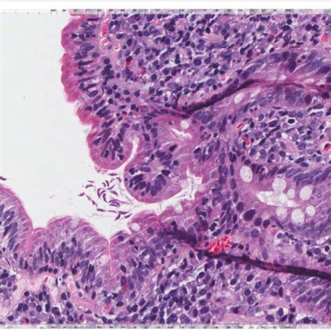 Duodenal Mucosa Showing Villous Atrophy Associated With Increased