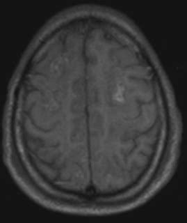 Amyloid Angiopathy: MRI - Sumer's Radiology Blog