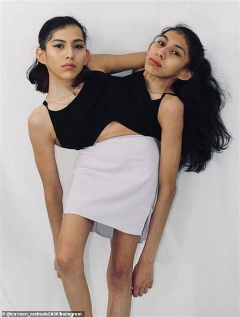 Conjoined Twins 23 Open Up About What Its Really Like To Share A