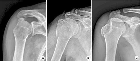 Greater Tubercle Fracture