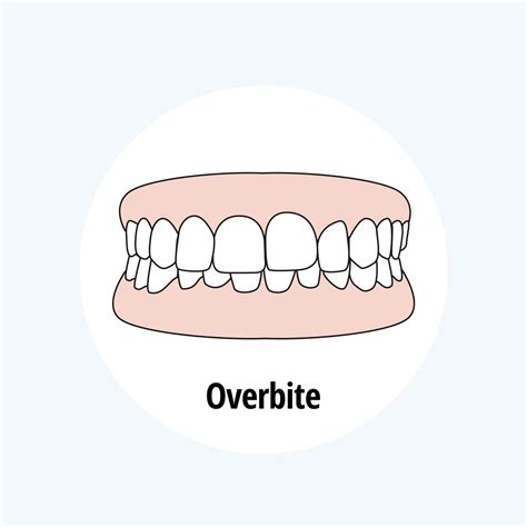 Overbite: Causes, Effects, and Treatment Options - Swiss Dent