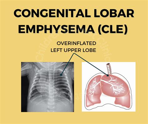 Congenital lobar emphysema: diagnosis and treatment - Dr. Ankit Parakh ...