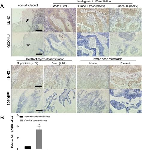 The Expression Of Mir 205 And Chn1 In Cervical Cancer Adistribution Download Scientific