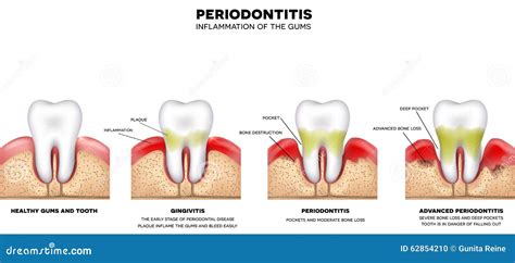 Periodontitis Stock Vector Image 62854210