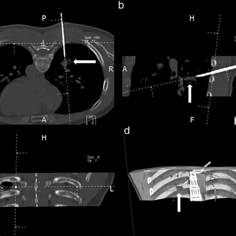 Computed Tomography Guided Lung Tumor Biopsy Using The Multiplanar Download Scientific Diagram