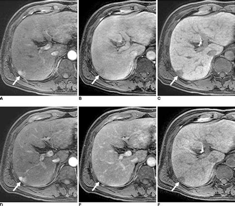 Figure From Gadoxetic Acid Gd Eob Dtpa Enhanced Mri Versus