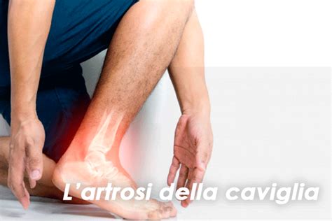 Artrosi Della Caviglia Che Cos Sintomi Cause Prevenzione