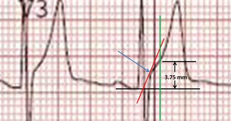 Dr Smiths Ecg Blog How To Measure St Elevation At 60 Milliseconds