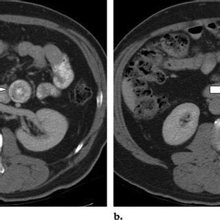 Ileoileal Intussusception In A 25 Year Old Man With Right Lower