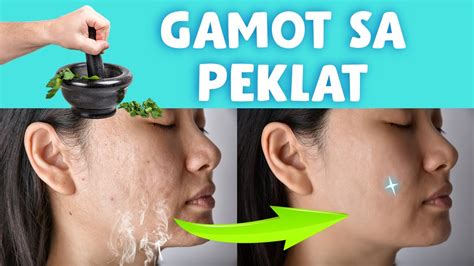 Ano Mga Natural Na Halamang Gamot Para Maalis Ang Peklat Paano Mawala