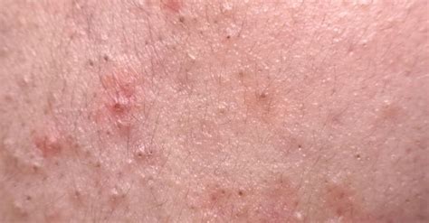 Nodular Acne Symptoms Causes And How To Treat It Lupon Gov Ph