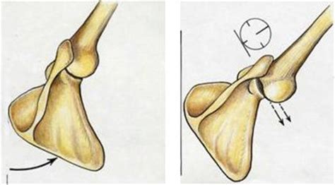 Scapulothoracic Winging Boston Shoulder Institute