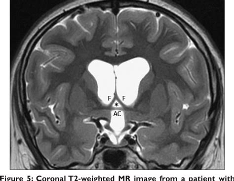 Figure 5 From Colloid Cysts Posterior And Anterior To The Foramen Of Monro Anatomical Features