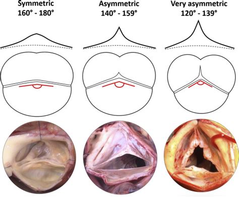 Commissural Geometry And Cusp Fusion Insights To Guide Bicuspid Aortic