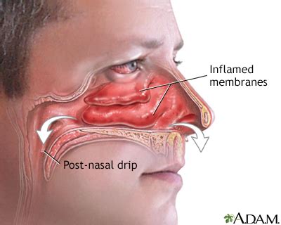 Stuffy Or Runny Nose Adult Uf Health