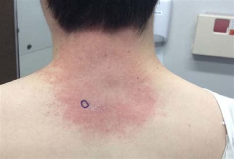 A Clinical Photo Demonstrating Multifocal Erythematous Plaques With