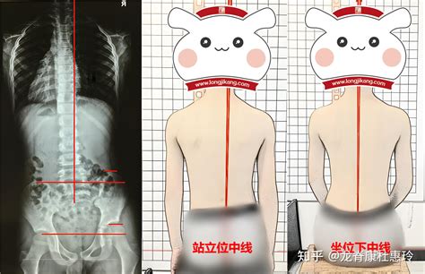 对于这一种脊柱侧弯，早期干预相对比较简单！ 知乎