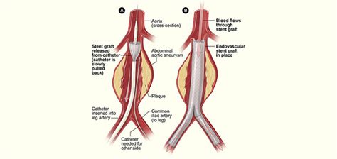 Abdominal Aortic Aneurysm Baylor Medicine