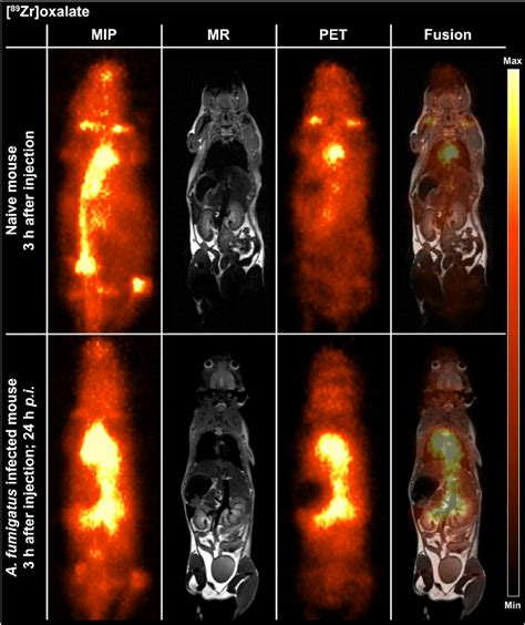 Maximum Intensity Projections MIP Of PET And Fused PET And MR Images