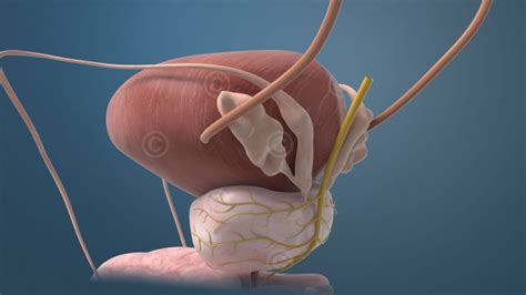 Stereoskopische 3D Animationen Zu Prostatakrebs MedicalGraphics