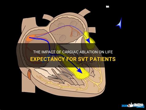 The Impact Of Cardiac Ablation On Life Expectancy For Svt Patients