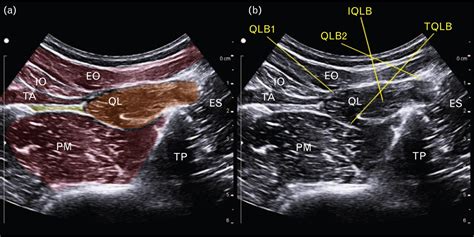 Ultrasound Guided Quadratus Lumborum Block For Postoperative