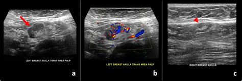 Ultrasound shows lymph node changes after COVID-19 vaccine