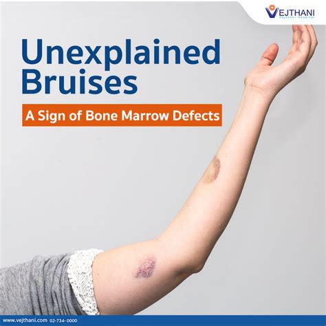 Unexplained Bruises A Sign Of Bone Marrow Defects Vejthani Hospital