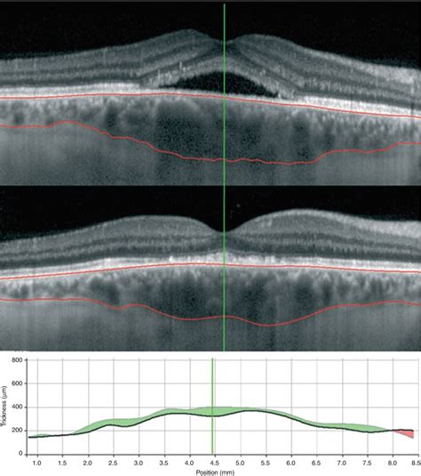 Fig 48 Central Serous Chorioretinopathy Horizontal Oct High