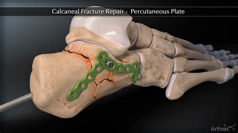 Arthrex Calcaneal Fracture Percutaneous Plate